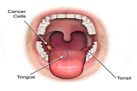 HPV: Head, Neck and Oral Cancers | Dentist Ladys Island | Beaufort SC