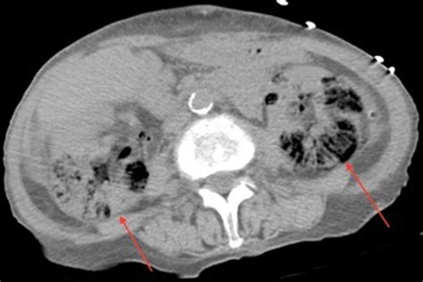 Figure 1 From Bilateral Emphysematous Pyelonephritis Semantic Scholar