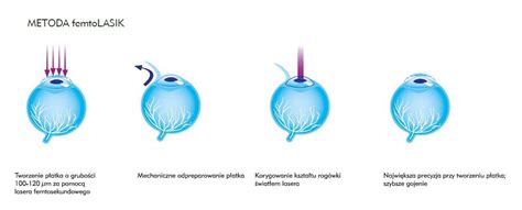 Laserowa Korekcja Wzroku Metod Femtolasik Zaufanekliniki Pl