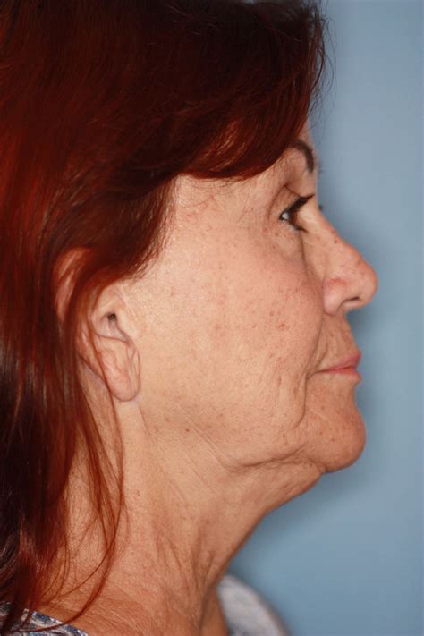 Nasal Surgery Rhinoplasty Pinehurst Surgical Clinic