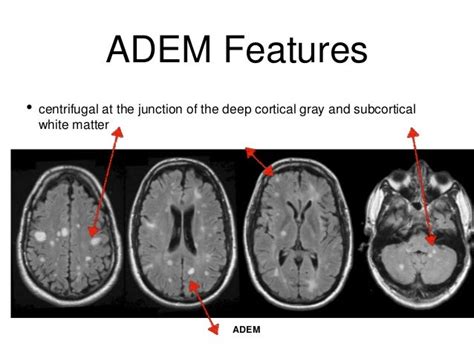 Acute Disseminated Encephalomyelitis