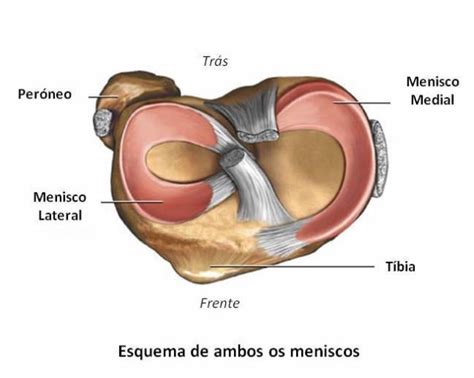 O Que Menisco Do Joelho - Menisco: Lesão, Ruptura e Cirurgia - Instituto Trata