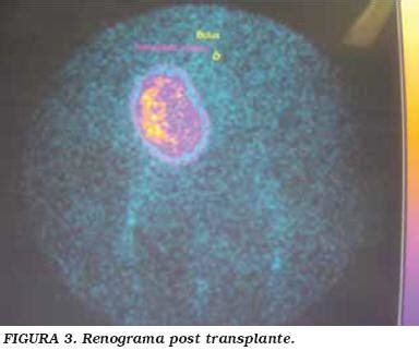 Aneurisma de arteria renal Nefrectomía laparoscópica reconstrucción