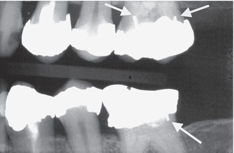 Radiographic Appearance Of Dental Tissues And Materials 2023