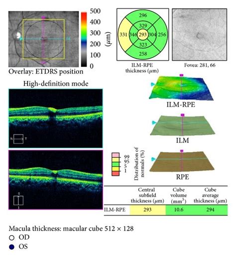 Case 2 At 1 Month After Intravitreal Ranibizumab Notes A Resolution