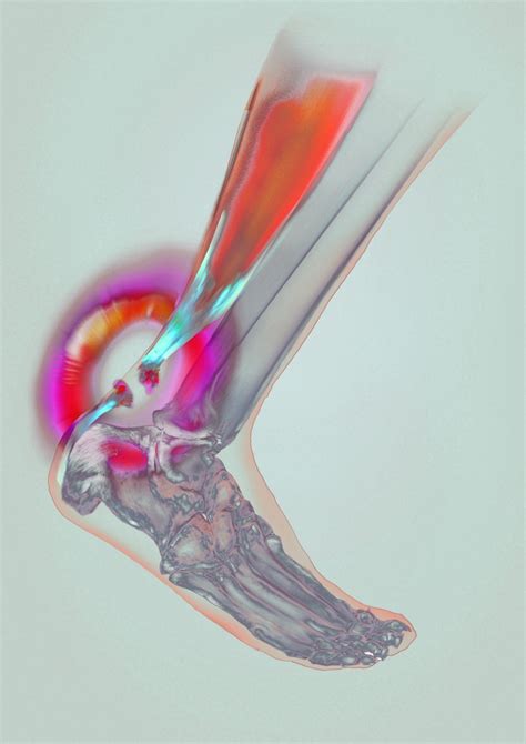 Achilles Tendon Rupture: Treatment, Therapies, and Recovery