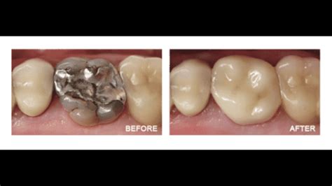 Cerec, One Visit Crown Treatment in Newark and Bear