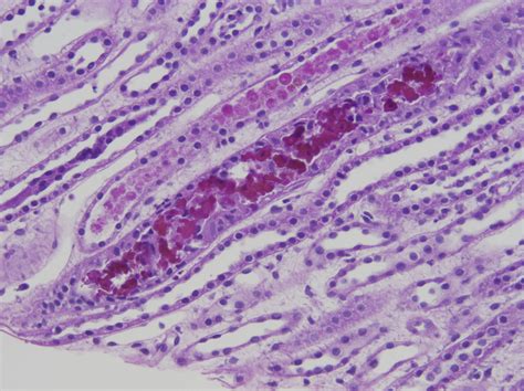 Ajkd Atlas Of Renal Pathology Myoglobin Cast Nephropathy American