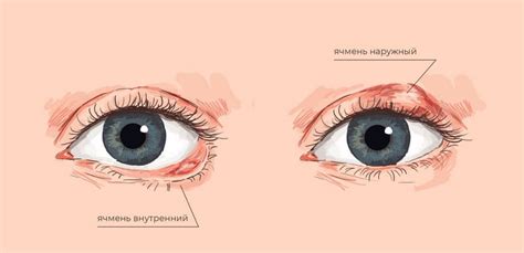 Ячмень на глазу: лечение, причины и симптомы