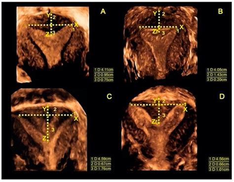 Ultrasound Comparison Between External And Inner Uterine Profiles Of