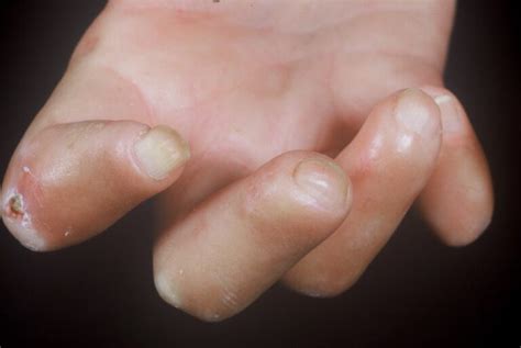 Sclerodactyly Scleroderma Rheumexam Atlas