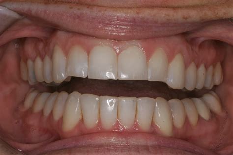 TCDO Blog: Veneers, Veneers and More Veneers