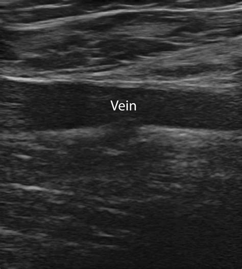 Upper Extremity DVT Ultrasound