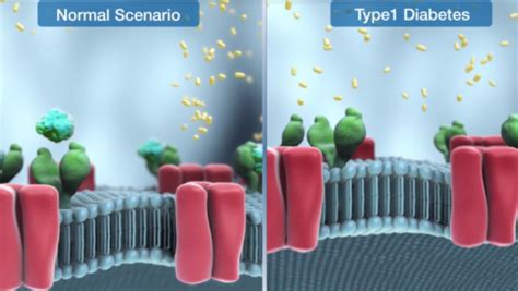 3D Medical Animation Type 1 Diabetes Mellitus Scientific Animations