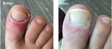 Ingrown Toenail Removal Before And After