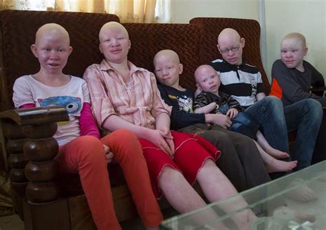 Tanzanian albinos - Golden beauty! — Steemit