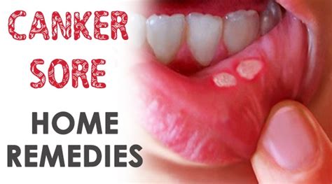 canker sore home remedies health care getinfopedia