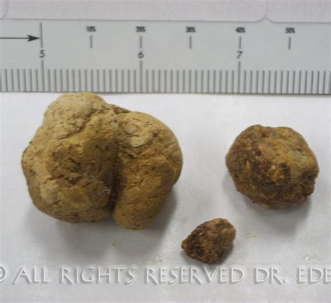 Gallstone Pictures Gallery See Images Of Real Gallstones Passed