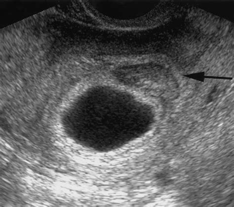 Blighted Ovum Leading Cause Of Early Miscarriage