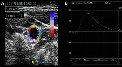 Strain Imaging Speckle Tracking Of The Common Carotid Artery A