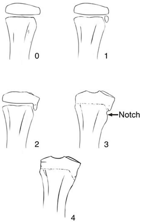 Tibial Tuberosity Ossification Predicts Reoperation For Growth