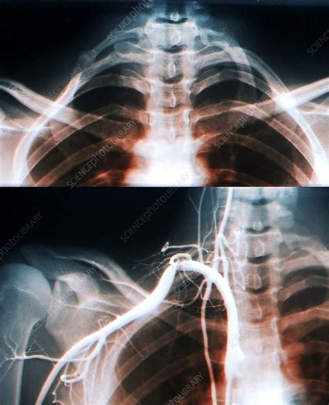 Posterior Ribs X Ray