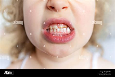 Caries And Plaque On Childrens Teeth Stock Photo Alamy