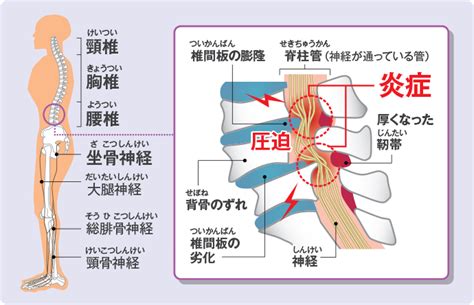 【腰痛とともに生きる：その2】腰痛の原因別対処法＜前編＞椎間板ヘルニア・脊柱管狭窄症 すなおのひろば