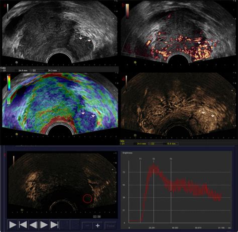 Non Invasive Diagnosis Of Prostate Cancer And High Grade Prostate