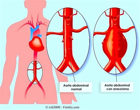 Aneurisma de aorta abdominal ascendente torácica síntomas