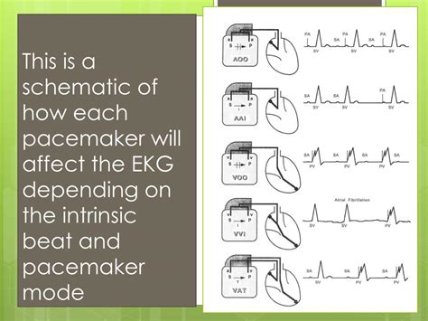 PPT - AICD and Pacemaker Update PowerPoint Presentation, free download ...