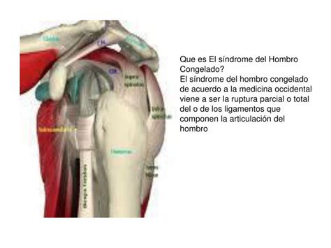 Ppt S Ndrome De Hombro Congelado Tesina Del Diplomado Acupuntura Y