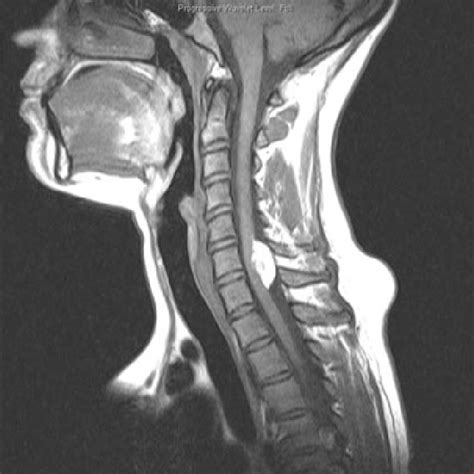 Cervical Spine Sagittal Anatomy