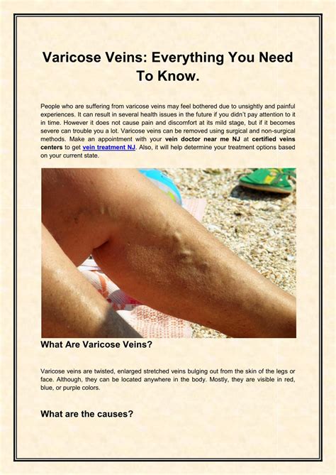 Ppt Varicose Veins Everything You Need To Know Powerpoint