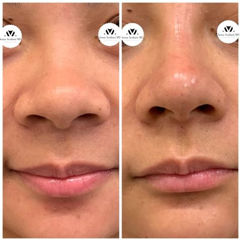 Gallery: Non Surgical Nose Job - Anna Avaliani MD - Cosmetic & Laser Surgery Anna Avaliani MD ...