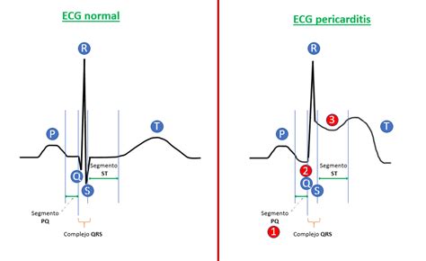 ¿cómo Identificar Pericarditis En Un Ecg Guía Sencilla