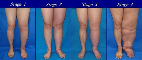 Lymphedema Condition Overview [Causes, Stages, Symptoms, Treatments, Precautions] - Lymphedema ...