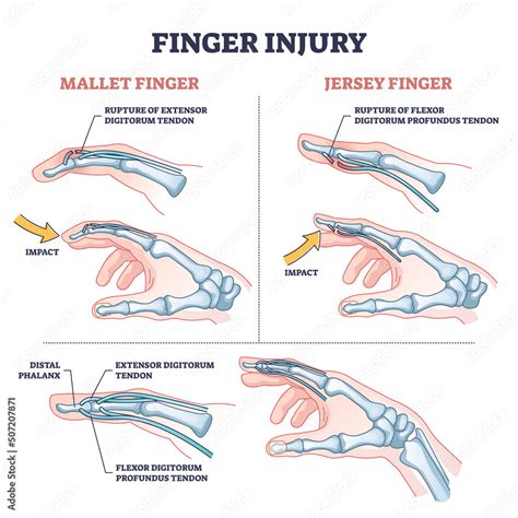 Finger injury types with common hand impact trauma anatomy outline diagram. Labeled educational ...