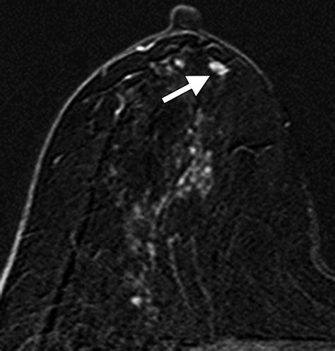 Significance Of Incidentally Detected Subcentimeter Enhancing Lesions