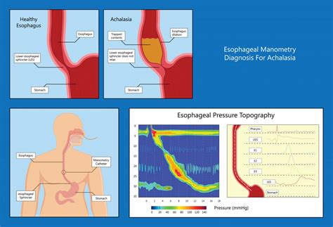 Upper Esophageal Sphincter Manometry