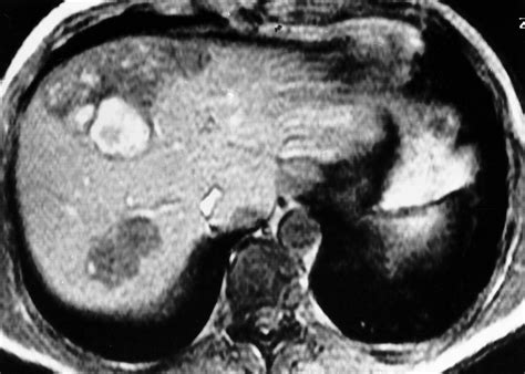 Imaging Of Atypical Hemangiomas Of The Liver With Pathologic