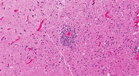 Primary Cns Diffuse Large B Cell Lymphoma Ottawa Atlas Of Pathology