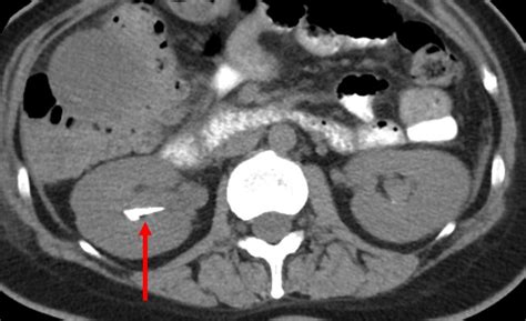 Renal milk of calcium – Radiology Cases