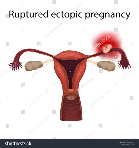 Fallopian Tube Pregnancy Rupture