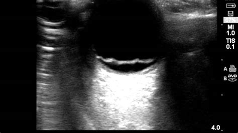 Ocular Ultrasound Retinal Detachment Youtube