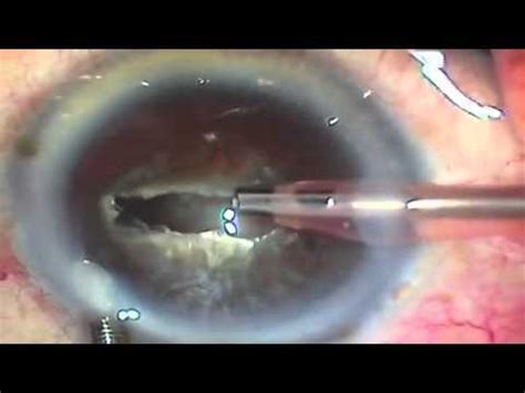 PHACO In Very Hard Cataract YouTube