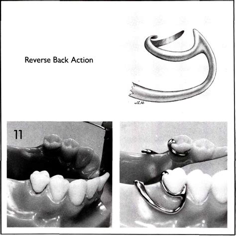 Removable Partial Denture Design, | Pocket Dentistry