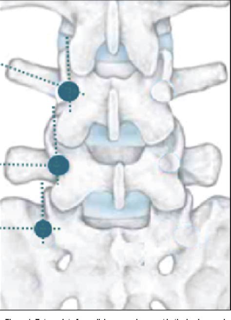 Figure From Free Hand Technique For Thoracolumbar Pedicle Screw