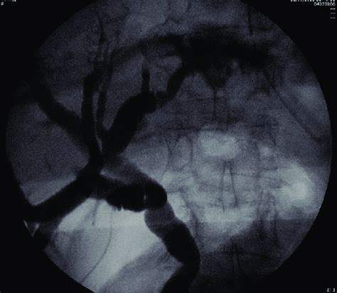 Cholangiography. Extravasation of contrast. | Download Scientific Diagram