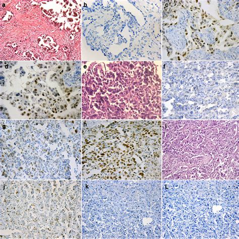 Por Diagnostic Utility Of Bap Ezh And Survivin In Differentiating